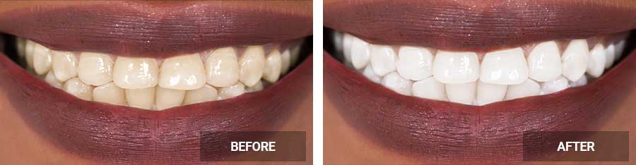 Teeth Whitening before after image case 03