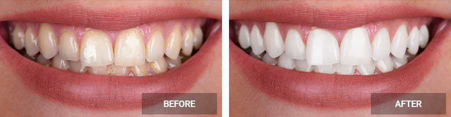 Teeth Whitening before after image case 04